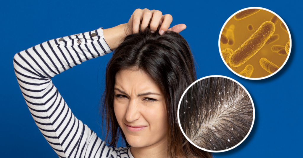 Is Your Dandruff Actually Caused by a Fungus?