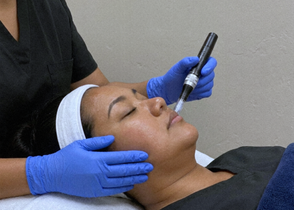 microneedling 1