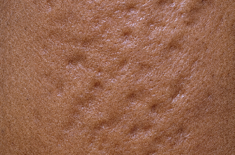 Acne scars