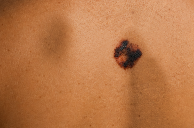 Melanoma HPD