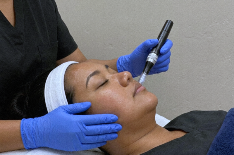 microneedling 1